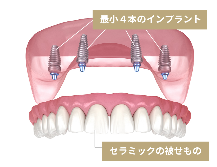 オールオン４