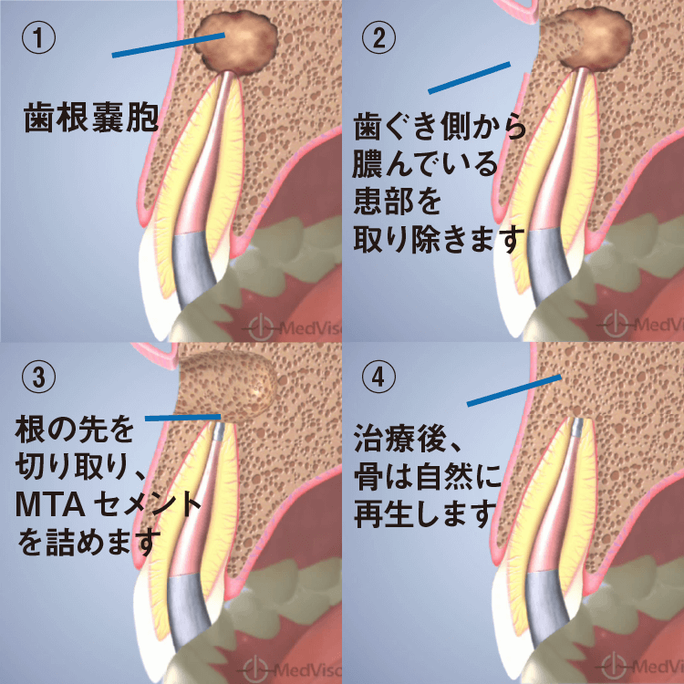 歯を残すための治療 歯根端切除術 意図的再植 エクストリュージョン インプラントなら大阪 関西の筒井歯科