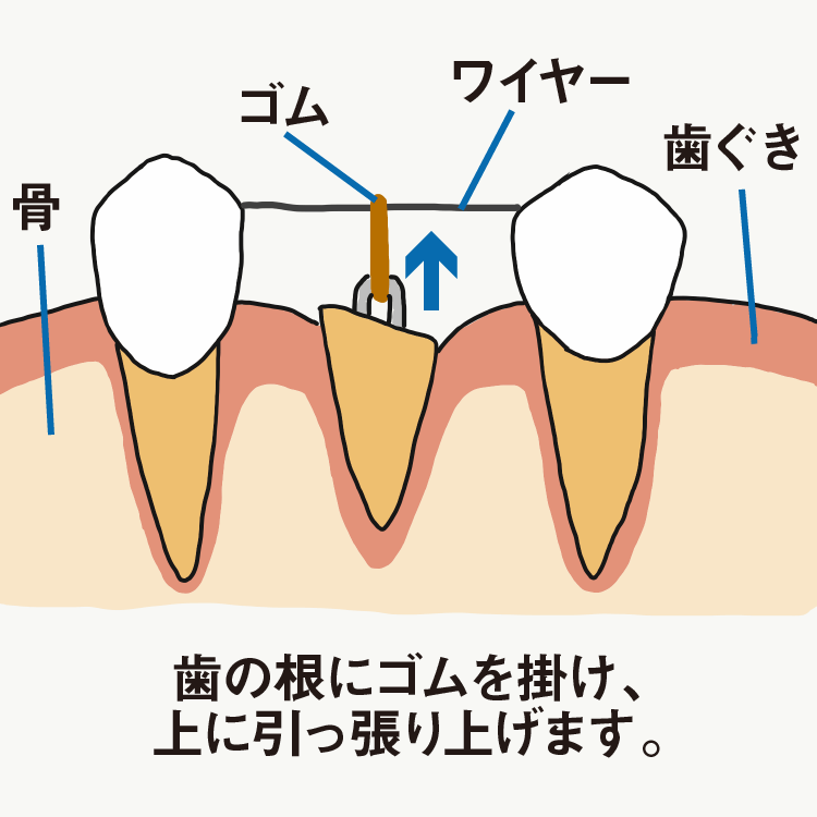 歯を残すための治療-歯根端切除術・意図的再植・エクストリュージョン- | インプラント/オールオン4なら大阪・関西の筒井歯科