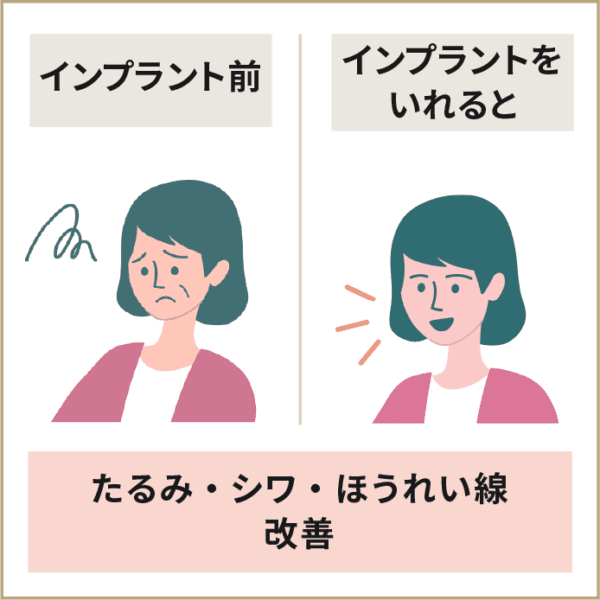 インプラントはたるみ　しわ　ほうれい線を改善に