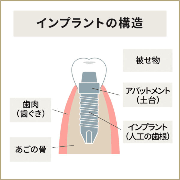 インプラントの構造