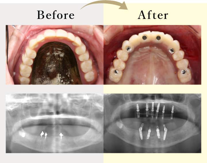 オールオン４ 歯がボロボロ 総入れ歯の方のインプラント 大阪 北浜の筒井歯科のオールオン4
