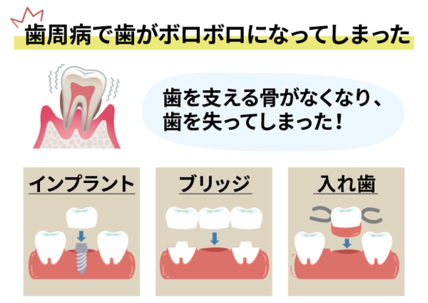 歯周病で歯がボロボロ