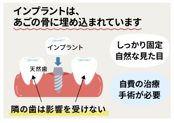 インプラントの治療