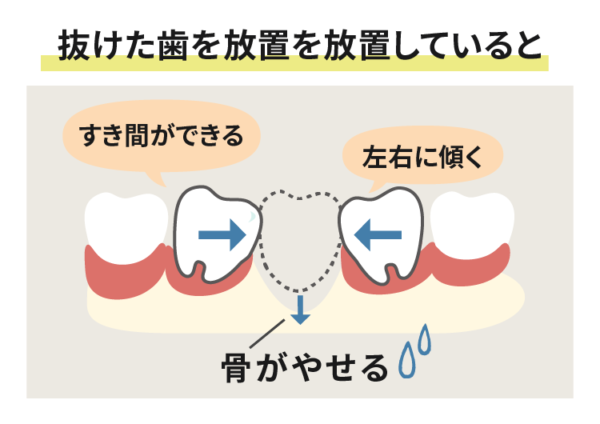 抜けた歯を放置していると