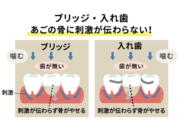 顎の骨に刺激が伝わらない