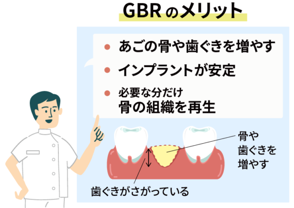 GBRのメリット