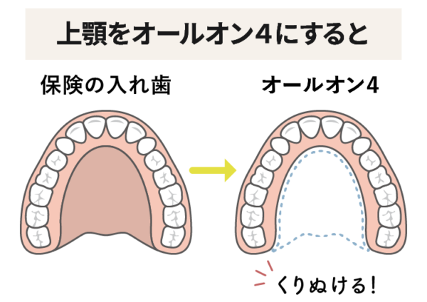 上顎のオールオン４