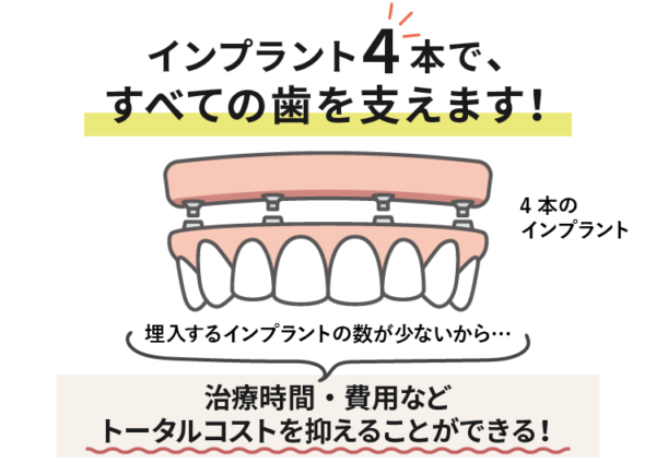 インプラント４本ですべての歯を支えます