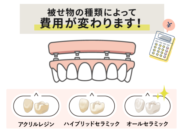 オールオン４の費用は被せ物で変わる