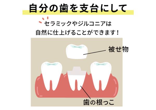 自分の歯を支台にするセラミック治療