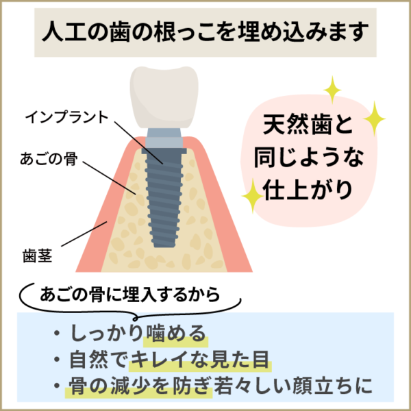 天然歯と同様の仕上がりインプラント