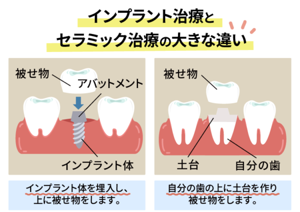 インプラント治療とセラミック治療の違い